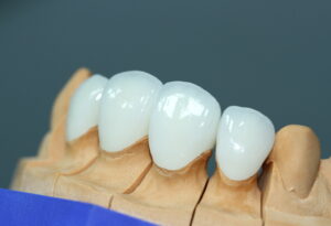 Типы зубных коронок, какие лучше