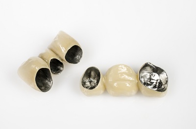 Типы зубных коронок, какие лучше