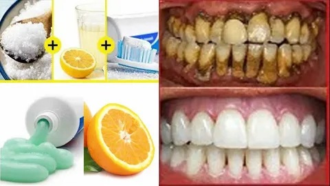 Отбеливание зубов в домашних условиях.